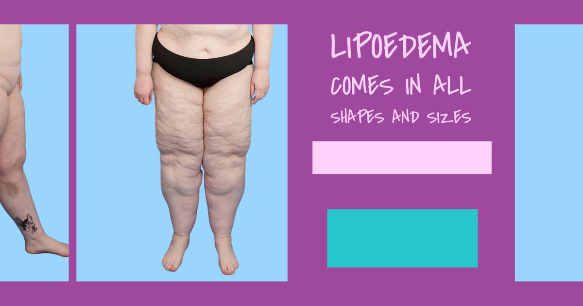 TalkLipoedema on X: Later stage #Lipoedema patients can suffer with  #lipolymphoedema which means you get swelling of limbs too. With the  assistance of compression garments you can alleviate symptoms  #talklipoedema #lipoedema #lipedema #