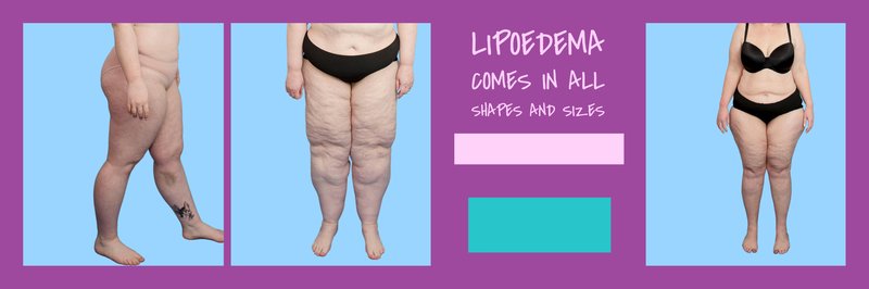 lipoedema-stages-sizes
