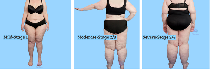 Lipedema Stage 2 Before and After - Lipedema and Me